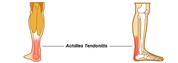 orthotics for achilles tendonitis. Achilles Tendonitis.