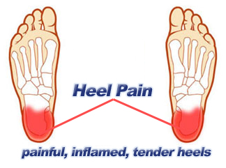 heel pain in morning
