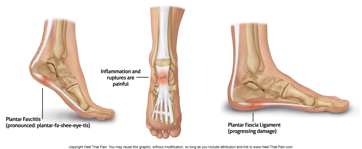 Orthotics For Plantar Fasciitis. to orthotic shoe inserts.